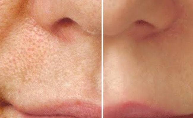 Ayurvedic Acne-Scar & Skin Pigmentation Treatments